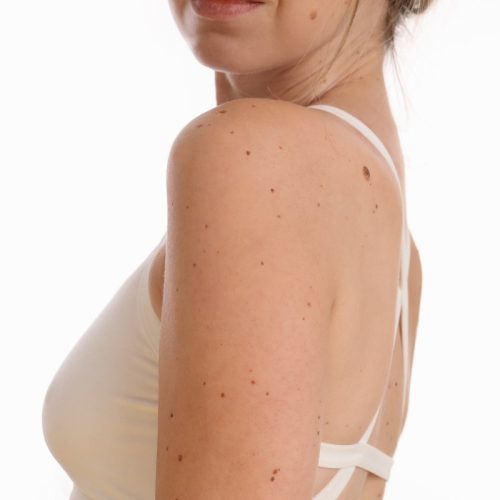 Skinfinity Skin Tag Remover: Latest Research Included - Is It Fit For You?