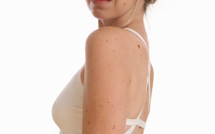Skinfinity Skin Tag Remover: Latest Research Included - Is It Fit For You?